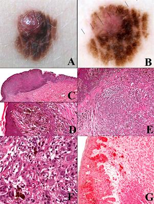 The WHO 2018 Classification of Cutaneous Melanocytic Neoplasms: Suggestions From Routine Practice